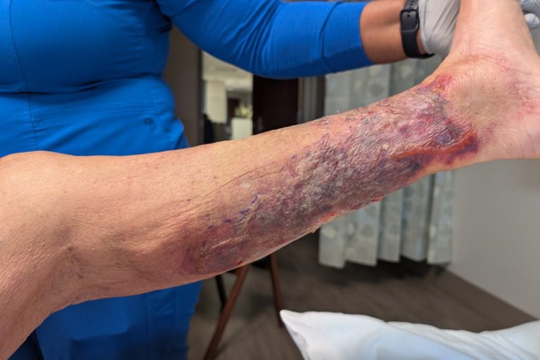 First Flesh-Eating Bacteria Death of 2026 Recorded in This State